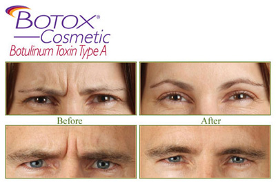 botox botulin toxin
